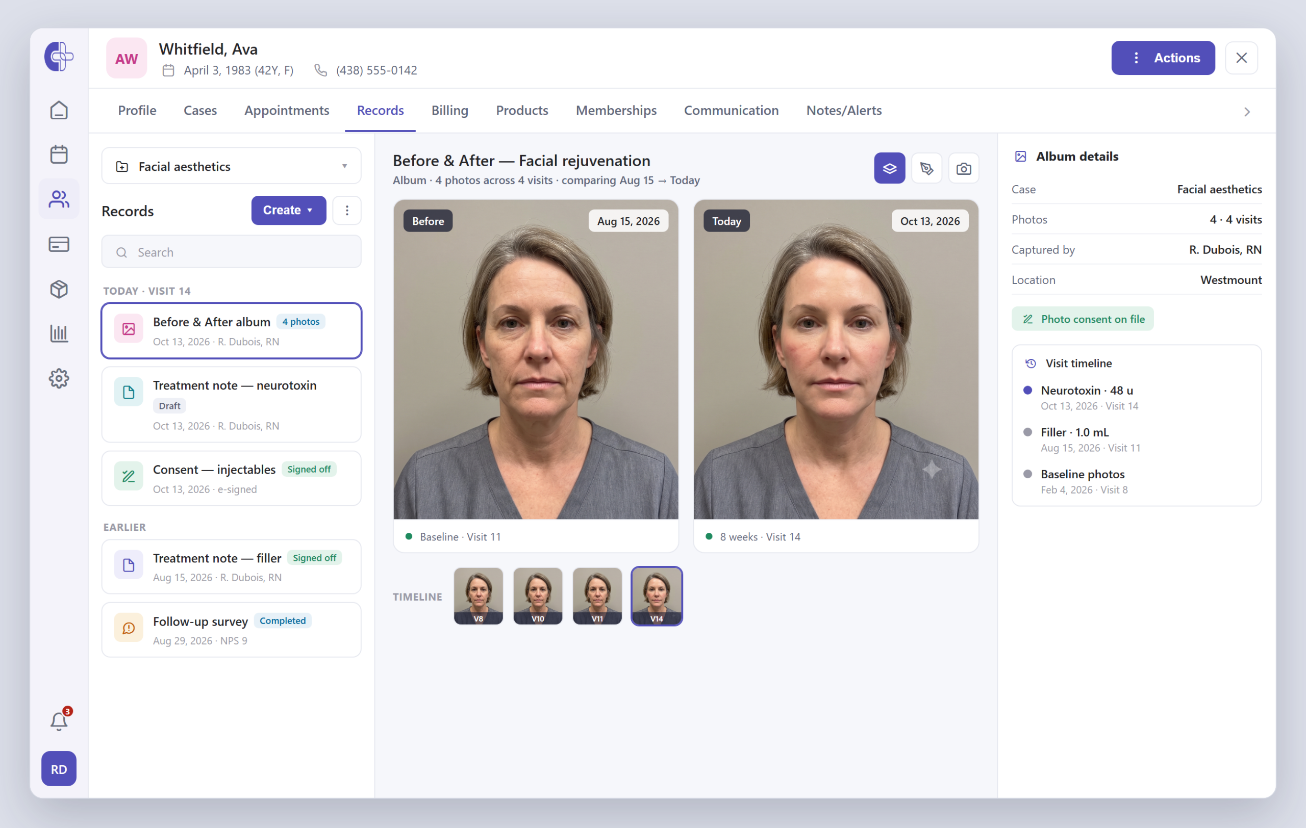 Clinicmaster before-and-after photo album for an aesthetic client — two dated portraits shown side by side for comparison inside the unified patient record, with the client card and treatment history.